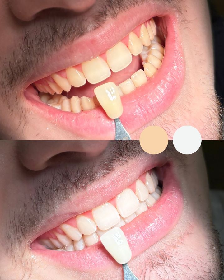 Antes e depois de clareamento dental