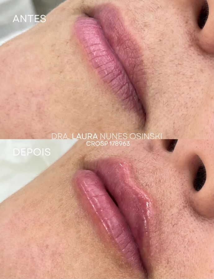 Antes e depois de preenchimento labial