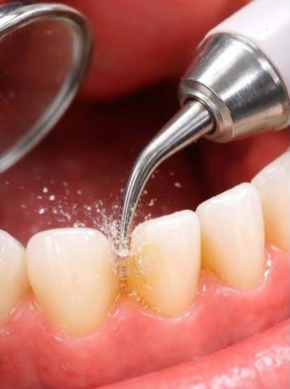 Procedimento de limpeza dental